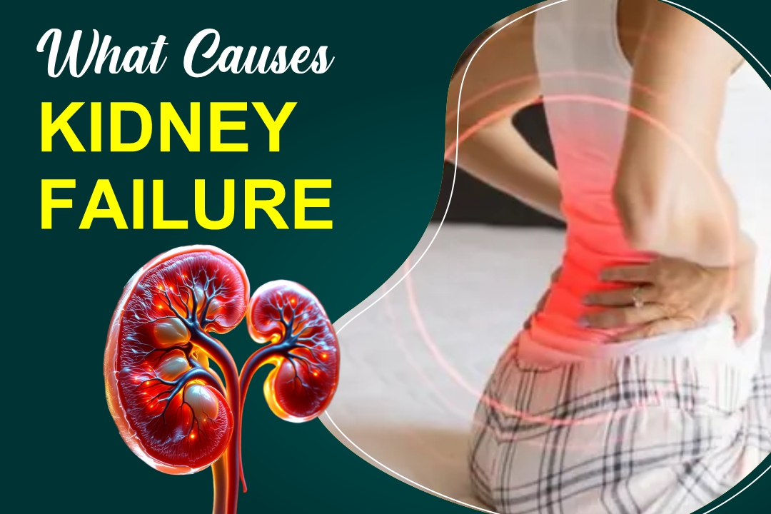 What Causes Kidney Failure? Risk Factors and Prevention Tips